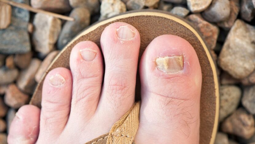 Onychomycose des ongles